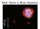 Twist-1 expression in human cancer cells