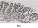 Detection of PGP in Colon Cancer Tissue