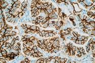 Clinical FISH: Better Insights for Therapeutic Treatment