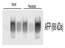 AFP Levels In Human Plasma