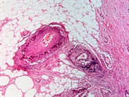 Watch Webinar: Cancer Neoantigens as Targets for Natural and Therapeutic Anti-Tumor Responses
