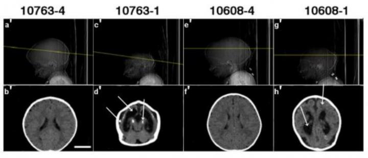 Computed tomography scans for Zika study