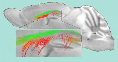 diffusion MRI technique reveals Alzheimer's associated events