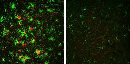 amyloid plaques before and after treatment