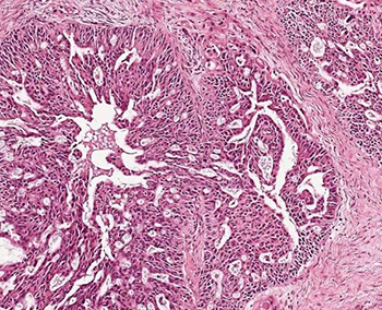ovarian cancer cells