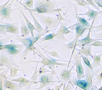 melanoma cells