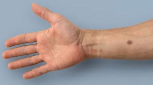 biomedical implant catches cancer