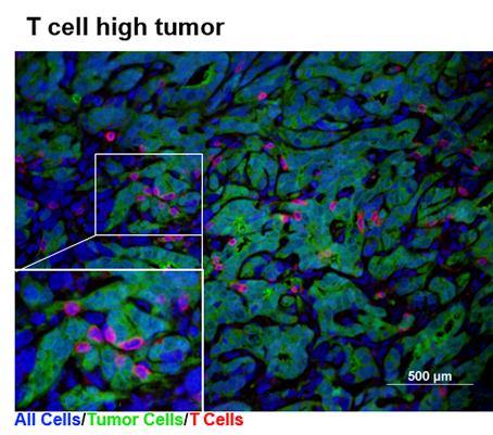 A 'hot' tumor with many T cells