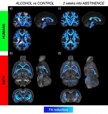 MRI