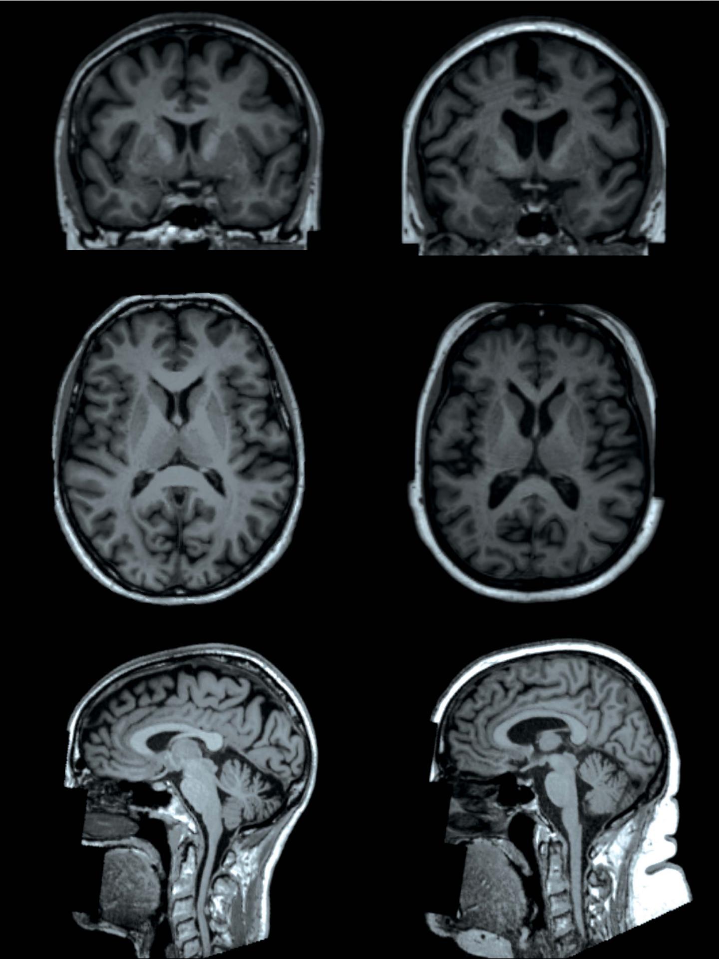 Is Your Brain Made Of Fat? The White Matter Revelation - x5xd8qz