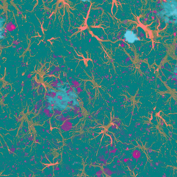 amyloid plaques