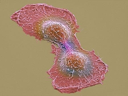 tumor