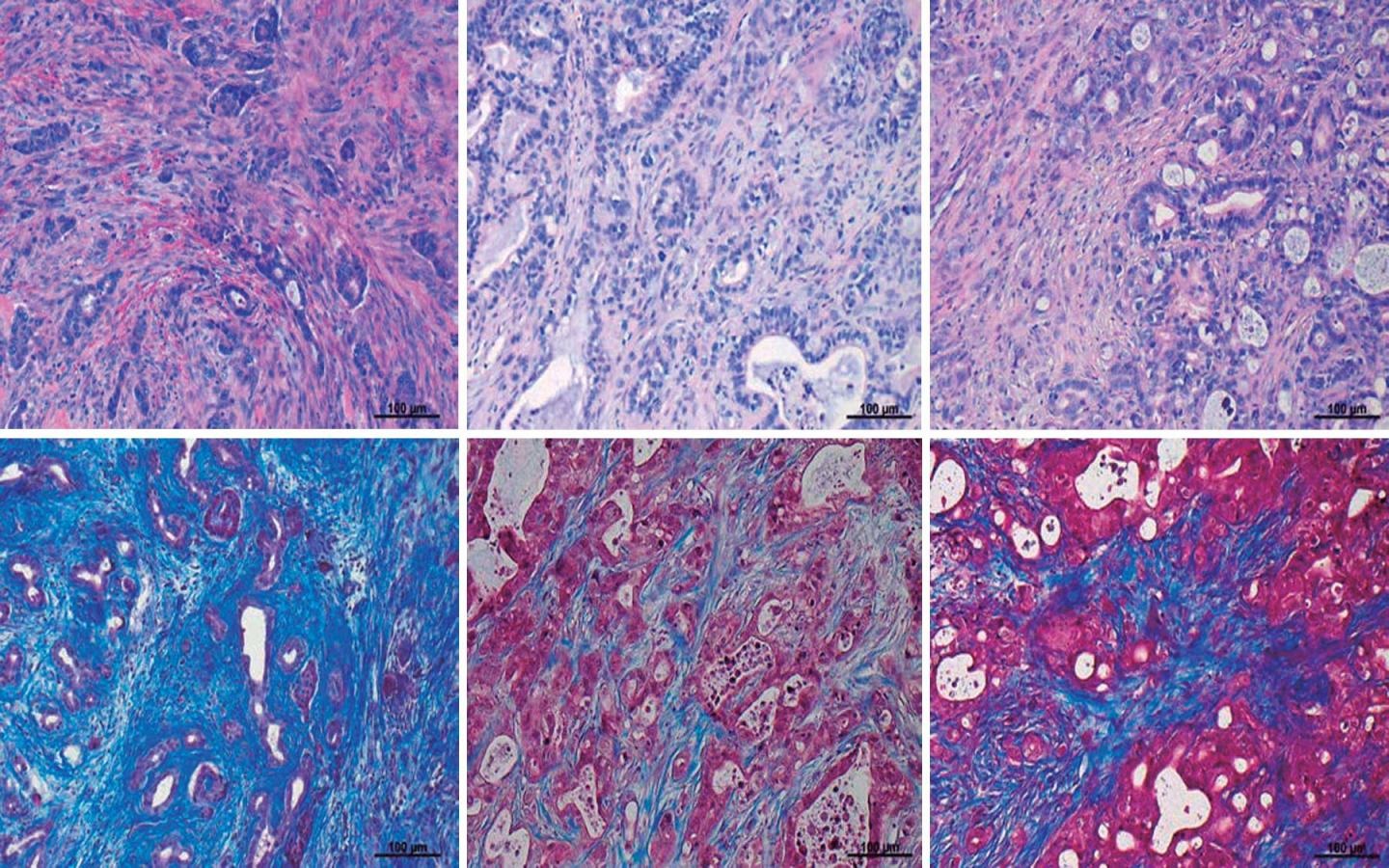 PDA tumors