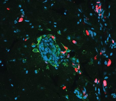 cancer cells