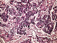 Tumor Microenvironments: Targeting Cancer from New Angles