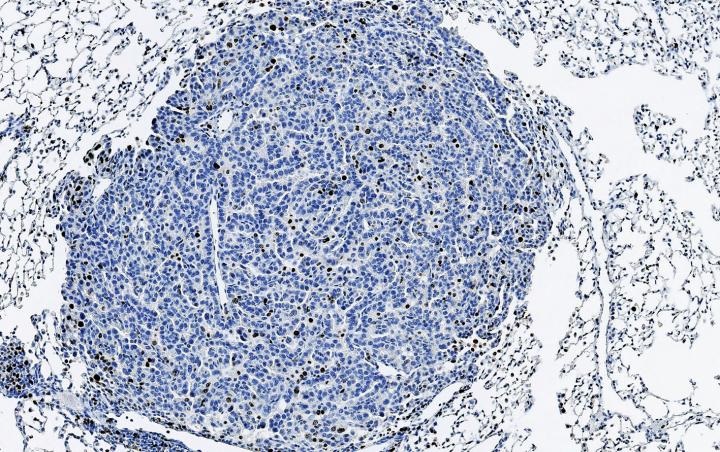 lung cancer