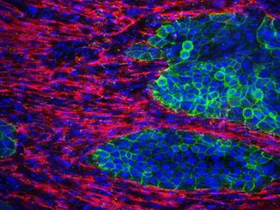 pancreatic cancer