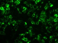 Detection of CD5 Positive Cells in Lymphoma