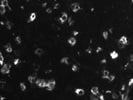 Detection of CD45RA Positive T Cells in Lymphoma