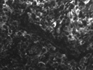 Detection of CD209 Positive Cells in Lymphoma