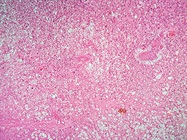 Using Multiplex Immunofluorescence to Better Quantify Treatment-Related Changes in sTILs/PD-L1