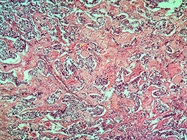 Spatial Profiling Delves into the Tumor Microenvironment