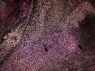 Resistance to CAR-T Cell Therapy