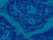 Whole Exome Sequencing