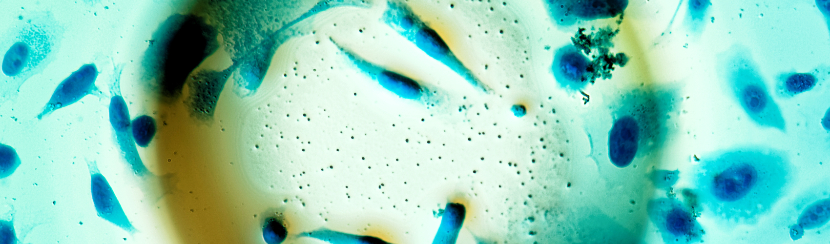  Enriching Pathological analysis of FFPE Tumor Samples with Spatial Transcriptomics