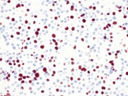 Strong Staining with Agilent's M7001 p53 Protein