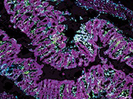 Webinar On-Demand: Immune Dysregulation in Inflammatory Bowel Disease