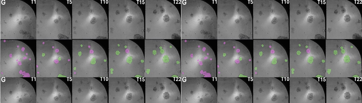 Organoids and AI: Unlocking the Mysteries of Cancer Immune Evasion and ...