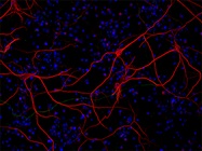 The Role of Oligomeric Alpha Synuclein, Tau, and Amyloid Beta in Neurodegenerative Diseases