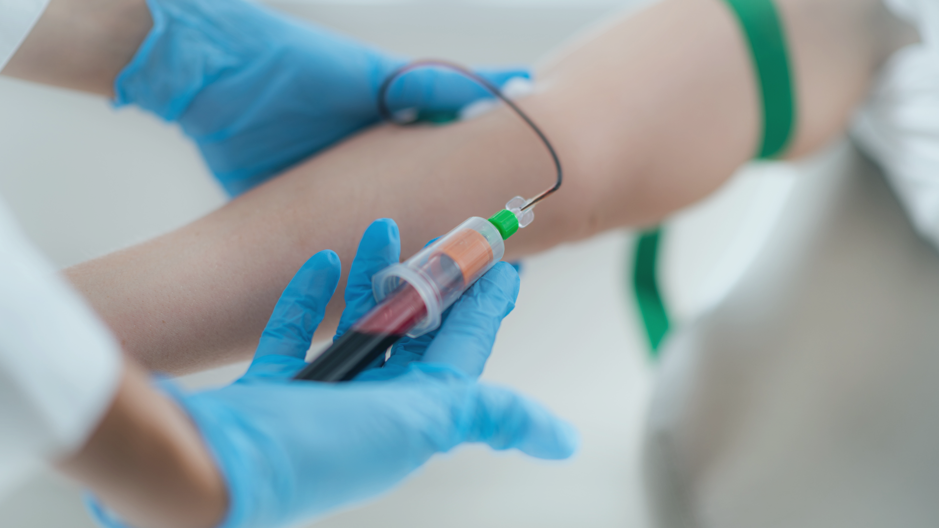 Blood draw for liquid biopsy: this allows circulating tumor DNA (ctDNA) detection and minimal residual disease monitoring using digital PCR. A medical practitioner drawing a blood sample from a person into a tube for laboratory analysis.