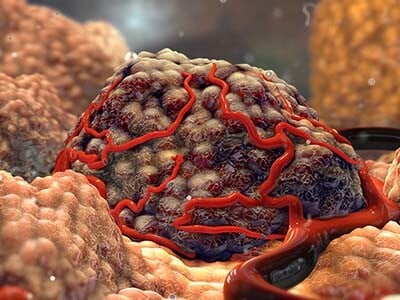 A 3D render of a vascularized tumor