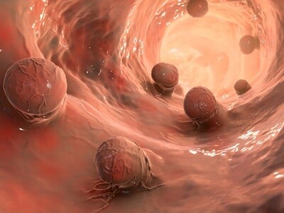 A computer render of polyps lining the bowel.