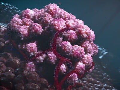 A computer rendered image of a vascularized tumor attached to a tissue wall.