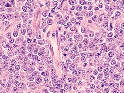 An immunohistochemistry stained image of lymphoma cells.