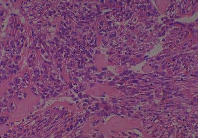 Human Various Tissue MicroArray (Sarcoma)